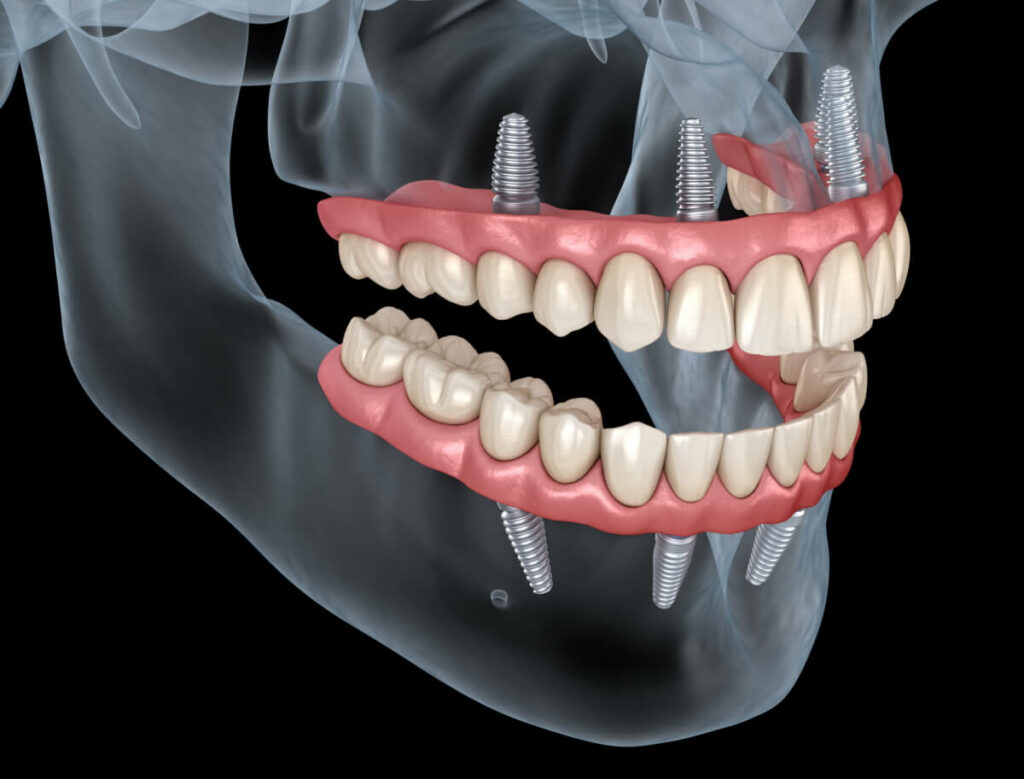 Implants