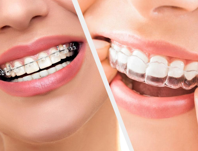braces