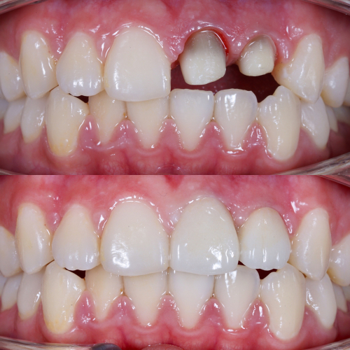 dentalcrown