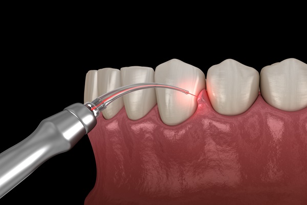 Gum,Correction,Surgery,With,Laser.,Medically,Accurate,Tooth,3d,Illustration