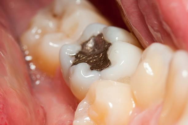 Macro of a tooth with amalgam filling